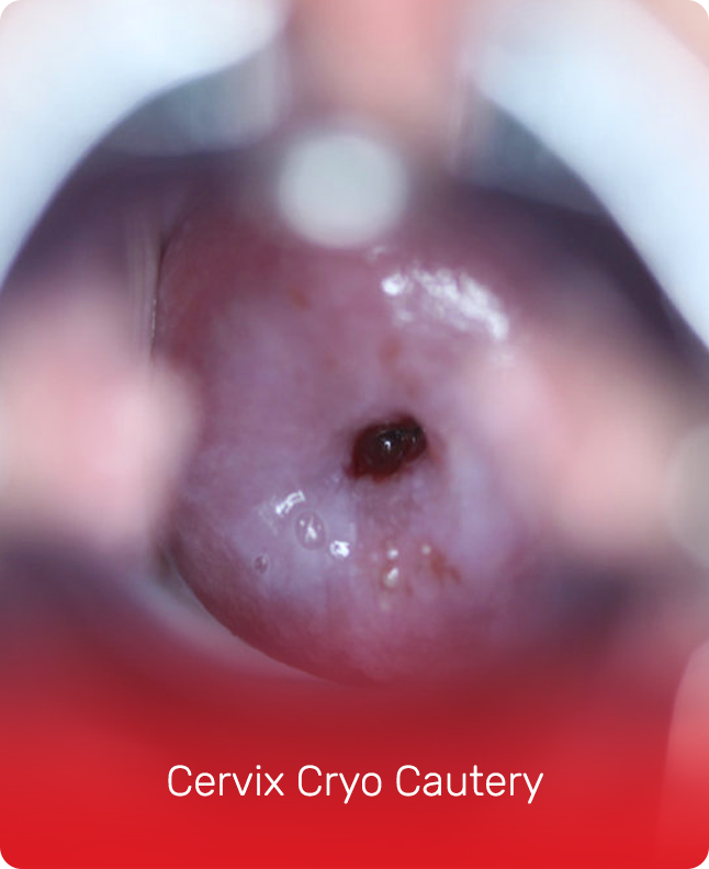 CERVIX CRYO CAUTERY