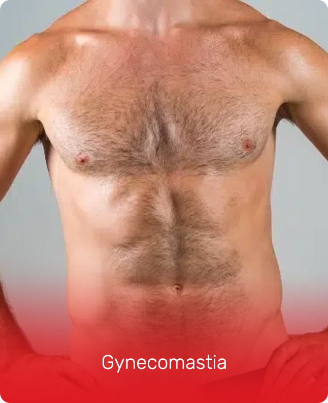 Gynecomastia