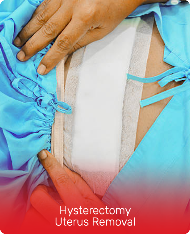 _HYSTERECTOMY UTERUS REMOVAL