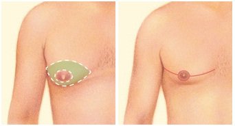 Liposuction technique2