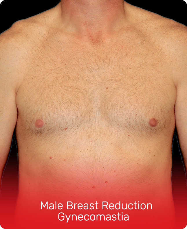 MALE BREAST REDUCTION GYNECOMASTIA