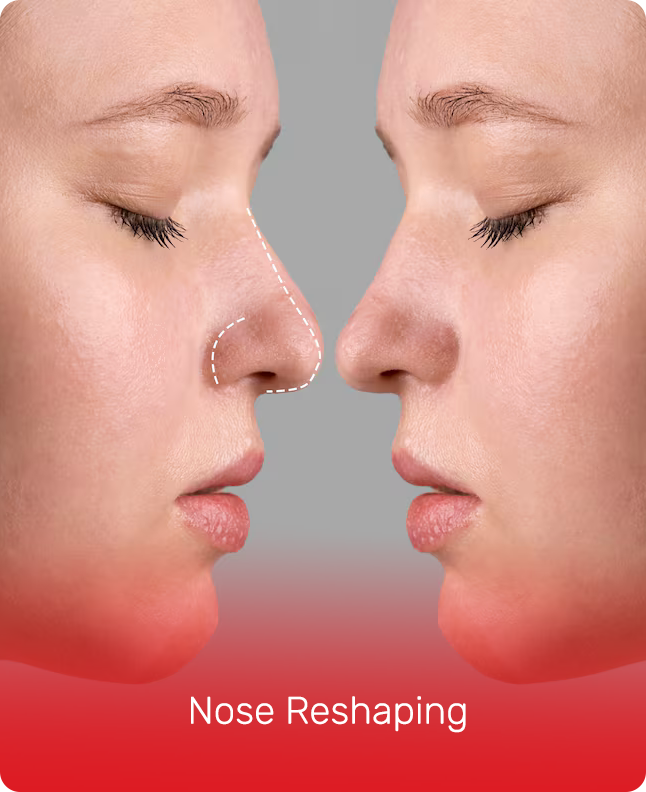 NOSE RESHAPING