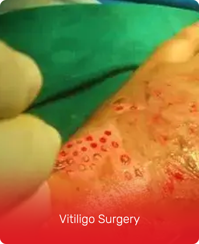 VITILIGO SURGERY