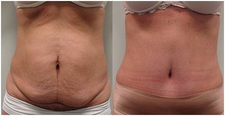 after-abdominoplasty