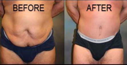 after-abdominoplasty